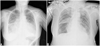 Case Report: Osmotic Demyelination Syndrome After Transcatheter Aortic Valve Replacement: Case Report and Review of Current Literature